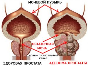 adenoma prostaty